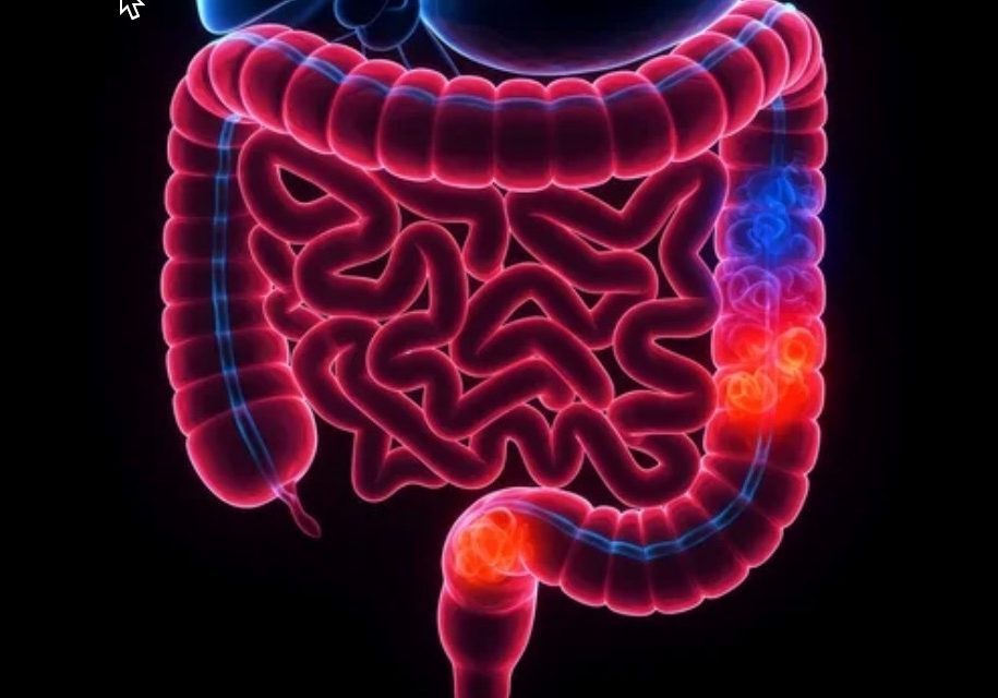 Crohn's Disease Image Crohn's Disease Image